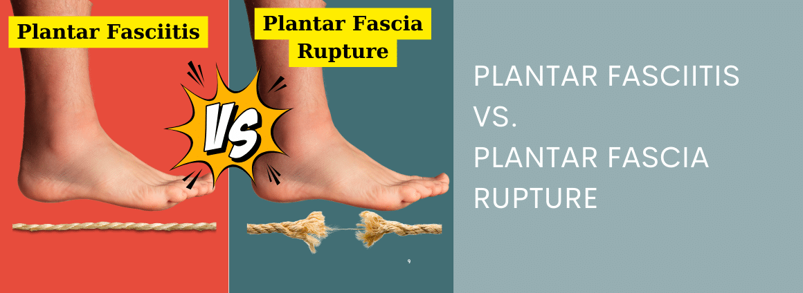 Showing the difference between a plantar fascia rupture and plantar fasciitis with text overlay "plantar fasciitis vs plantar fascia rupture"