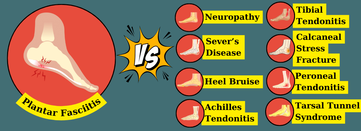 Showing plantar fasciitis versus other possible conditions. 