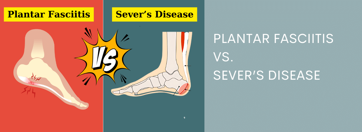 A title image showing the difference between Plantar Fasciitis Vs. Sever's Disease